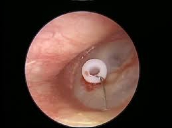 YENİ!!! EFFÜZYONLU OTİTİS MEDİALI HASTALARDA VENTİLASYON