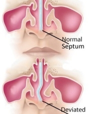 SEPTOPLASTİ+KONKA LATERİZASYONU ( BURUN İÇİ KIKIRDAK EĞRİLİĞİ AMELİYATI+ BURUN İÇİ ETLERİNİN KÜÇÜLTÜLMESİ) SONRASI DİKKAT EDİLMESİ GEREKENLER 